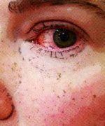 ¿Qué es la conjuntivitis alérgica?