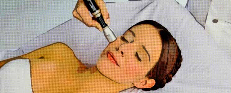 Tratamiento láser para verrugas en la cara