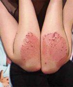 ¿Qué es la psoriasis?