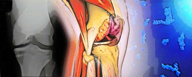 Infiltraciones en la rodilla con acido hialurónico