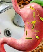 helicobacter pylori
