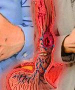 Remedios caseros para hernia de hiato