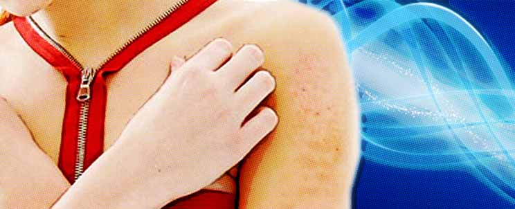 dermatitis