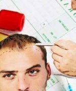 terapia de plasma rico en plaquetas para la alopecia