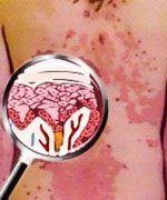 eczema marginado de hebra