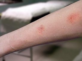 foto de brazo con eczema